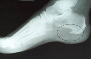 plantar fascillitus